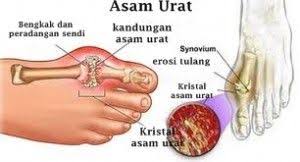 Cara Mengatasi Asam Urat Pada Kaki Asam Urat Kaki Tanaman Obat
