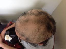 The usual steroid used for hair loss injections is triamcinolone acetonide. Dramatic Hair Loss Case By Victor Cheng Linkedin
