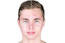 Klinik und therapie der rosazea. Behandlung Von Akne Rosazea Periorale Dermatitis Dr Helene Krause Dermatologische Privatpraxis