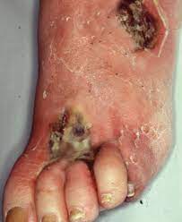 Maybe you would like to learn more about one of these? Diabetic Foot Ulcers Classification Systems
