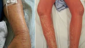 There are a number of different treatments doctors recommend. What Are Mycosis Fungoides And Sezary Syndrome Symptoms Causes Diagnosis Treatment And Prevention Everyday Health