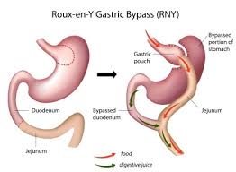 Peterli r, wölnerhanssen b, peters t, et al. Roux En Y Gastric Bypass Dr Scott Laker Michigan Surgery