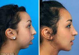 Before And After Shots Show Woman S Jaw Operation Transformation Jaw Surgery Orthognathic Surgery Silicone Implants