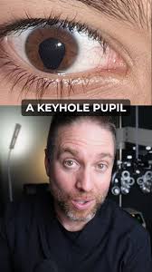👁️ Keyhole-shaped pupil? This is called Iris Coloboma — a birth-related  eye condition, not something that develops later. Some people see normally,  others may have light sensitivity or glare. 👉 Regular eye