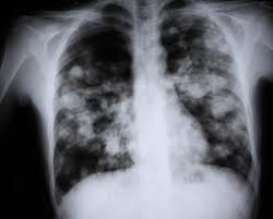 Image result for Pneumonia