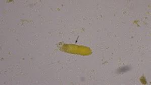 Image result for Urinary Cast