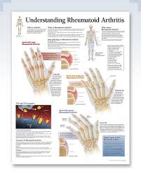 Understanding Rheumatoid Arthritis Chart 22x28 Clinicalposters