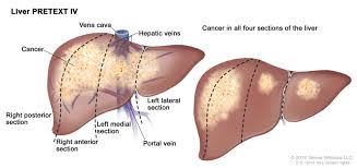 childhood liver cancer treatment pdq pdq cancer