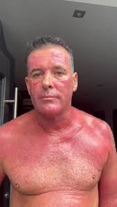 Hi everyone, I need Advice please! , My dad has always had ‘eczema’ from  being a baby and has been using steroid creams