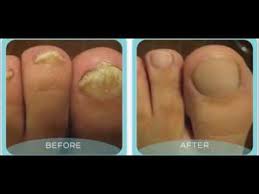 After hearing a brief synopsis of apple cider. Does Apple Cider Vinegar Work For Toenail Fungus Key Pro Youtube