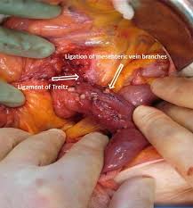 Copyright savesave ligamentum treitz for later. Surgical Procedures Of The Pancreas Radiology Key