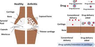 How long do the effects of nabumetone last? Polymer Colloids As Drug Delivery Systems For The Treatment Of Arthritis Sciencedirect