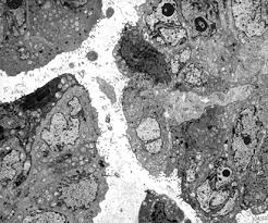 electron microscopy and immunohistochemistry (ihc) confirmed their mesothelial origin. The Diagnostic Utility Of Immunohistochemistry And Electron Microscopy In Distinguishing Between Peritoneal Mesotheliomas And Serous Carcinomas A Comparative Study Modern Pathology