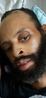 Surviving a stroke with no known cause