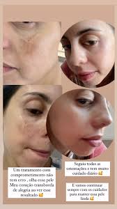 Um antes e depois de arrancar o fôlego , nos profissionais da estética  temos desafios diários em ajudar nossas clientes a melhorar suas queixas  deixando a pele cada dia melhor e buscando tratamentos ...