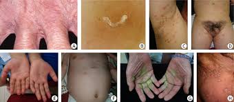 Image result for scabies in the groin area