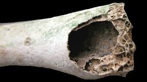 Bones that are strong but not flexible will be brittle and easily broken. Bone Structure Hollow Vs Solid Bioed Online
