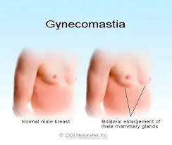 Image result for Gynecomastia