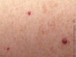 Red Moles On Skin Skinsight