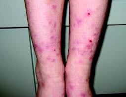 Image result for Papular urticaria