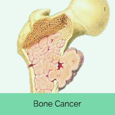 If the cancer spreads to internal organs it may cause other symptoms, too. Bone Cancer Types Causes Symptoms And Treatment Science Online