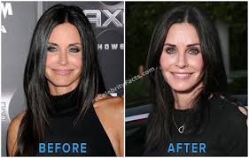 The whole gang is back together! Pin On Botox Natural Alternative Before After Results