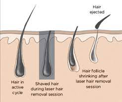 No no, which has low, medium, and high treatment levels, removes hair with a heated wire that stays above the skin. How Laser Hair Removal Works Prime Aesthetics