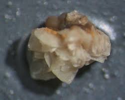 6mm kidney stone i passed while in the hospital this weekend! 42 Kidney Stones Ideas Kidney Stones Kidney Kidney Health