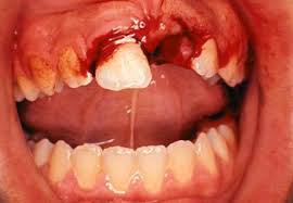 What To Do If Your Child S Tooth Is Knocked Out Ask Dr G