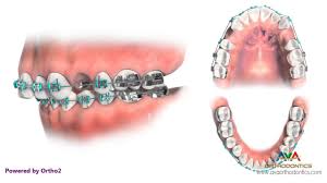 Maybe you would like to learn more about one of these? Orthodontic Treatment For Overjet Overbite Removing 2 Upper Premolars Youtube