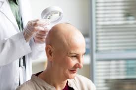 How to Cope with Hair Loss During Cancer Treatment