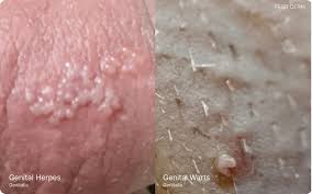 Image result for genital herpes