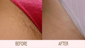Before developing into a typical cyst, an infected ingrown hair normally begins as a small or big pimple. Remove Ingrown Hair Bikini Area Naturally How To Get Rid Of Ingrown Hairs Ingrown Hair Bikini Ingrown Hair Removal Ingrown Hair