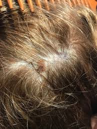 Learn basic information about preventing skin cancer. Don T Forget To Check Your Scalp For Melanoma Skin Cancer