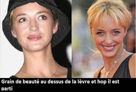 Pour quelles raisons enlever un grain de beauté ? Se Faire Enlever Un Grain De Beaute La Fille Du Quatrieme