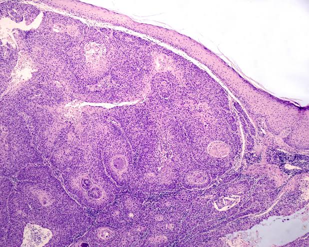 FDA panel endorses Replimune's previously rejected melanoma drug
