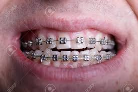 The site was founded in 2002 in denmark and went live across the globe last month. Metal Orthodontic Braces On Crooked Ugly Teeth Close Up Ugly Stock Photo Picture And Royalty Free Image Image 117680004