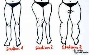 Dicke Beine Trotz Sport Und Diat Das Lipodem Richtig Bewegen