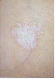 الحزاز المسطح lichen planus الكاتب نسر الأطلس و السلام على اشرف المرسلين اما بعد أسعد الله أوقاتكم اخواني أهلا وسهلا بكـل أعضاء وزوار ومشرفي منتدانا الغـالي مقدمة lichen planus حسب الإحصائيات يصيب هذا المرض نسبة تتراوح من 1 إلى 2 بالمائة من سكان العالم و