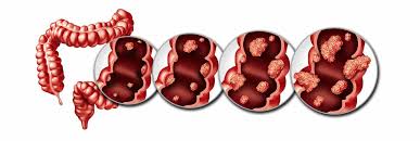 Image result for Colorectal Cancer