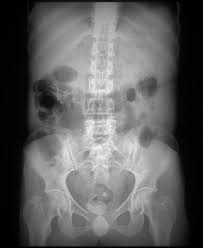 Bladder Calculi Occur Either From Migrated Renal Calculi Or Urinary Stasis Bladder Calculi Can Be Divided Into Primary And Seco Calculus Renal Calculi Bladder