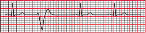 Premature ventricular contractions (pvcs) are extra, abnormal heartbeats caused by ectopic foci within the ventricles. Cv Physiology Abnormal Rhythms Definitions