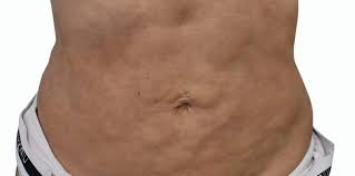 Fibrosis post liposucción - Dr. Diego Sturletti - Mejor Cirugía Plástica en Madrid