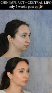starting the year off with a glow up 👀🔥 can you believe this results from  just a chin implant combined with central liposuction!?, my gorgeous  patient here is only 5.5 weeks post op and is LOVING her ...