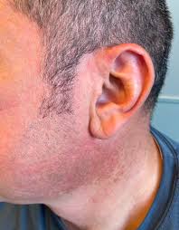 Image result for Diffuse Hyperpigmentation