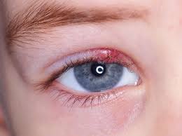Ich habe ein hagelkorn am auge und war am donnerstag beim augenarzt, dieser hat es so angedeutet, dass dieses durch die salbe die er mir verschrieben hat abschwillt. Hagelkorn Am Auge