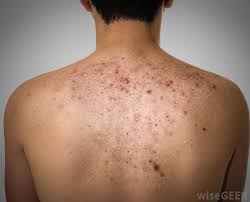 Read this blog post to learn how to get rid of them. What Is Involved In Back Acne Scar Removal With Picture