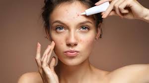 Acne Comment S En Debarrasser Efficacement