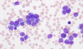Image result for Acute Leukemia