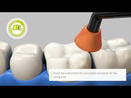 Ibond universal can be applied for. Step By Step Intraoral Repair Of Zirconia Based Restorations With Ibond Universal En Youtube